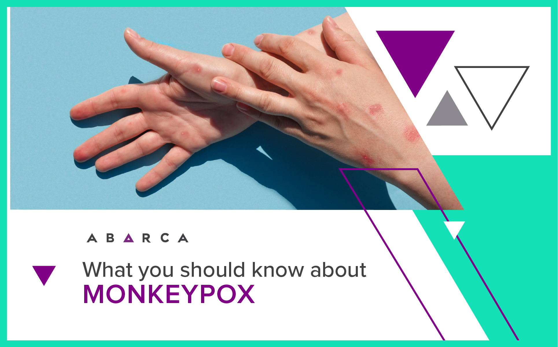 Abarca Health: What You Should Know About Monkeypox